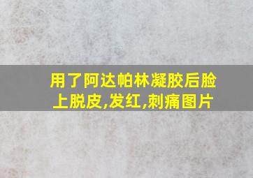 用了阿达帕林凝胶后脸上脱皮,发红,刺痛图片