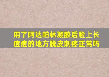 用了阿达帕林凝胶后脸上长痘痘的地方脱皮刺疼正常吗