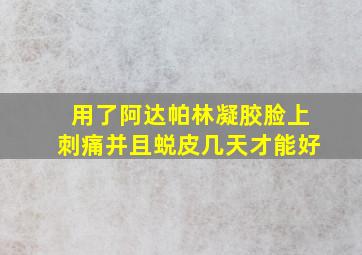 用了阿达帕林凝胶脸上刺痛并且蜕皮几天才能好