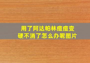 用了阿达帕林痘痘变硬不消了怎么办呢图片