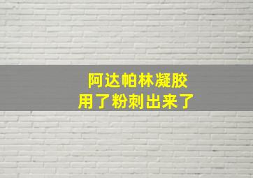 阿达帕林凝胶用了粉刺出来了